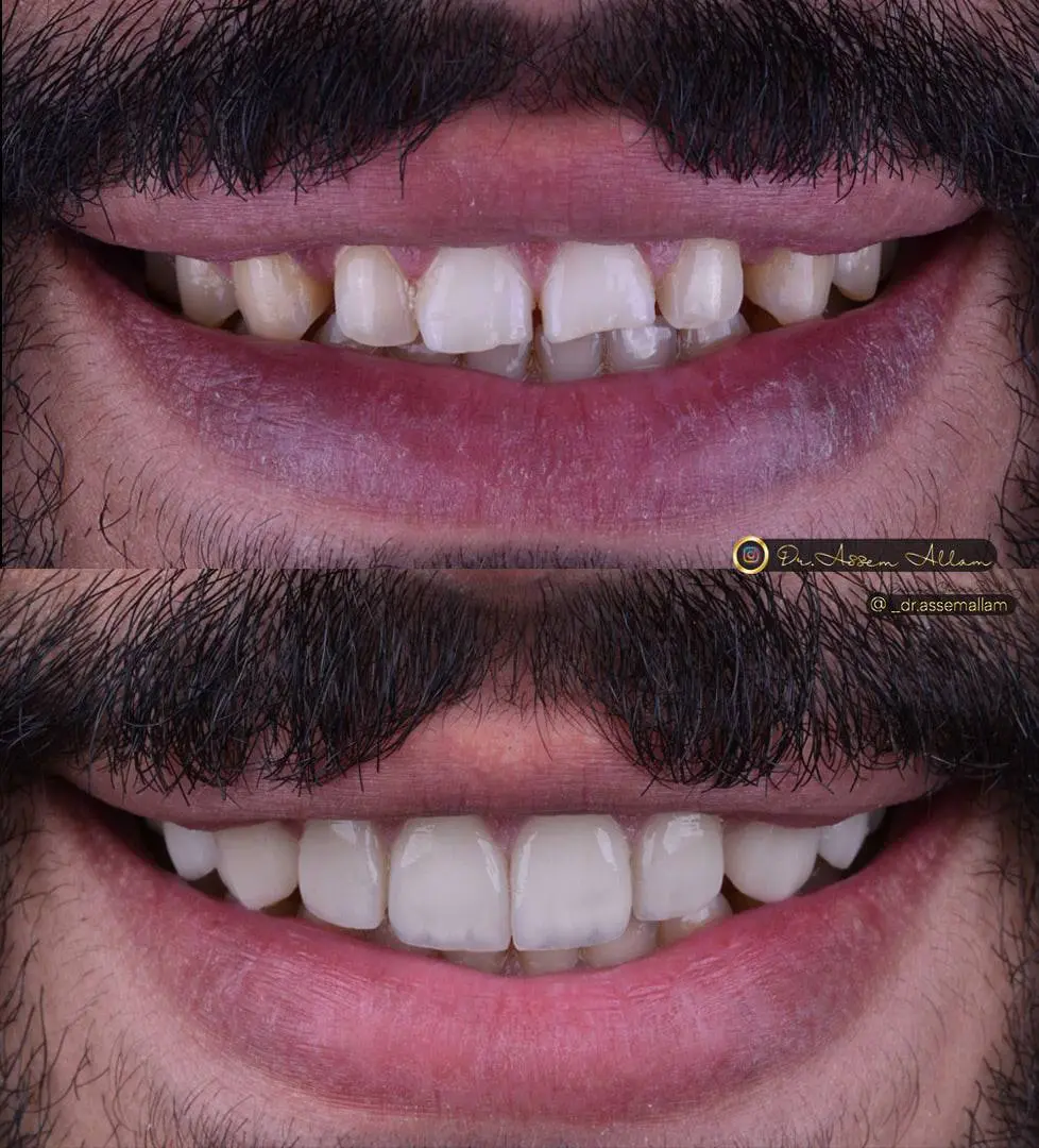 Momen Smile Before and After